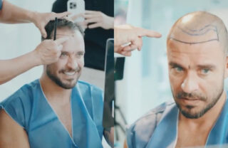 Diogo Nogueira revela novo transplante capilar em vídeo, mostra resultado e detalha procedimento; assista