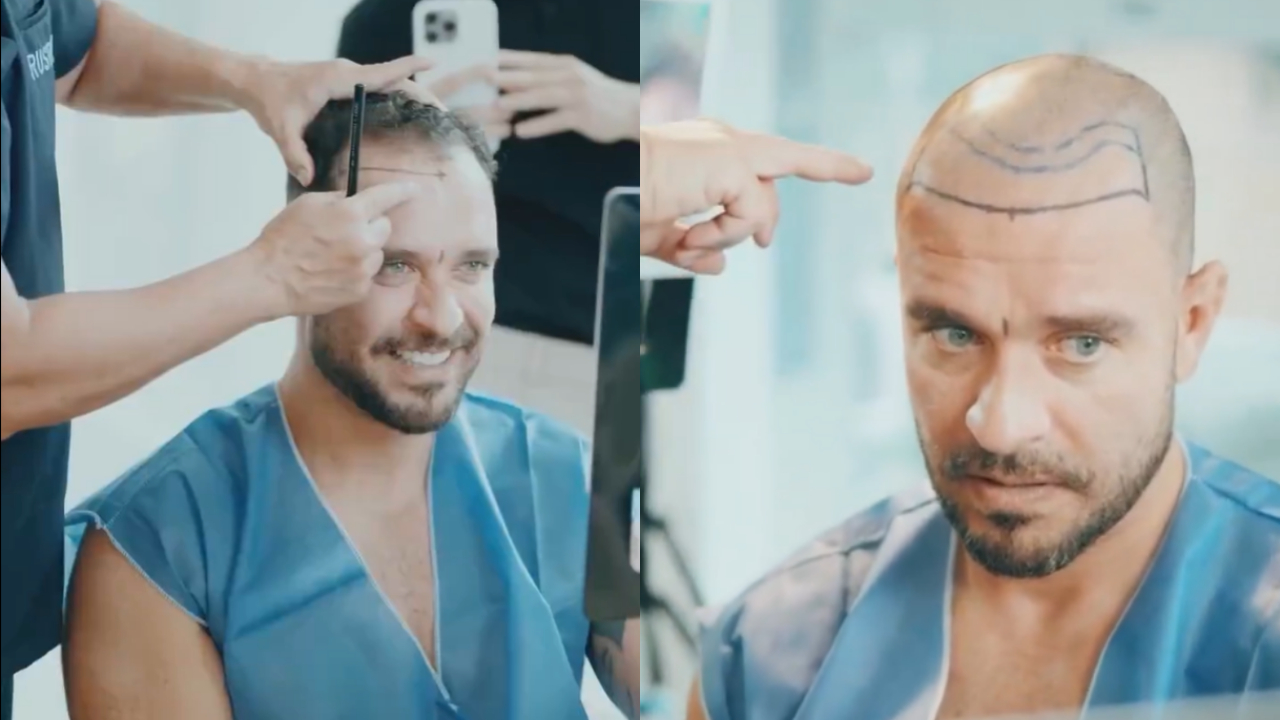 Diogo Nogueira revela novo transplante capilar em vídeo, mostra resultado e detalha procedimento; assista